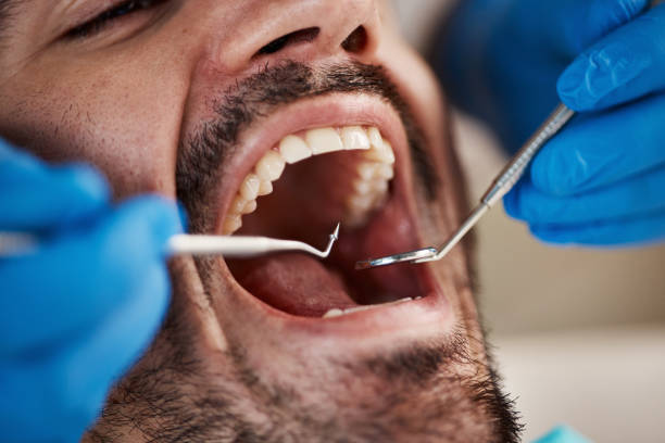 Best Emergency Treatment for Dental Infections or Abscesses in Wchester, IN